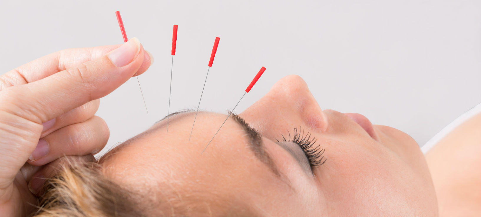 Acupuncture & Naturopathy